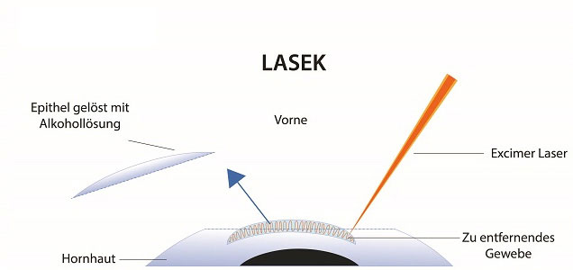 PRK/LASEK Augenlasern ohne Schnitt für aktive Menschen