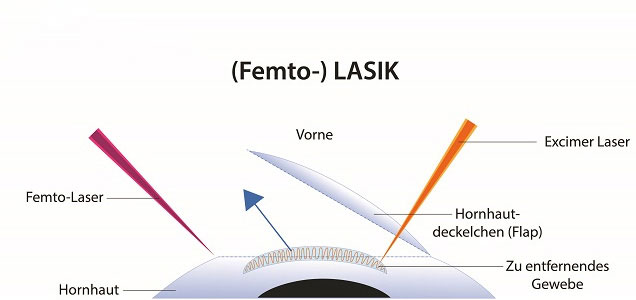 Grafik Femto-LASIK Augenlasern Methode