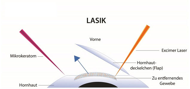 Grafik LASIK Augenlasern Methode