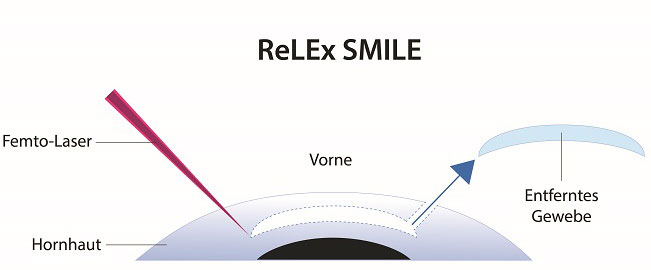 Grafik Relex-Smile Augenlasern Methode