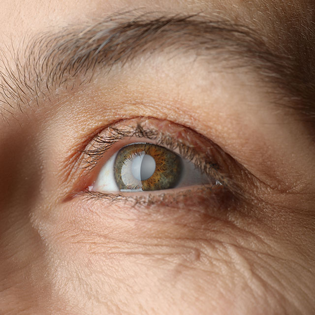 augen lasern